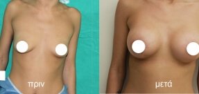 auxitiki-stithous-3a_thumb