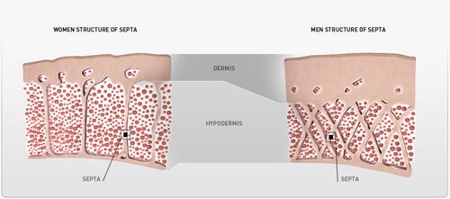 Κυτταρίτιδα (Endermologie-LPG)