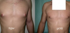 Gynecomastia