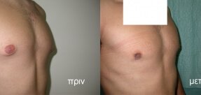 Gynecomastia