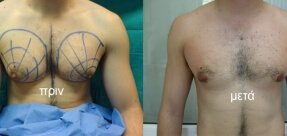 Gynecomastia
