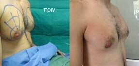 Gynecomastia