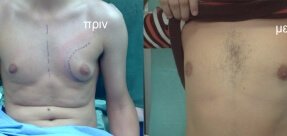 Gynecomastia