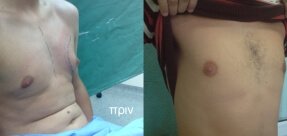 Gynecomastia