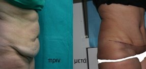 koilioplastiki-1b_thumb