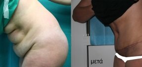 koilioplastiki-1c_thumb