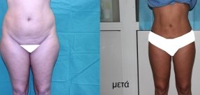 lipoanarrofisi-2a_thumb