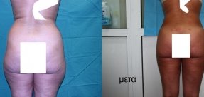 lipoanarrofisi-2b_thumb