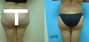lipoanarrofisi-3b_thumb