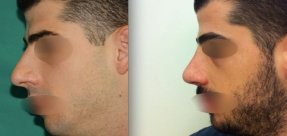 rinoplastiki-1a_thumb