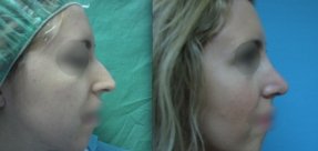 rinoplastiki-3a_thumb