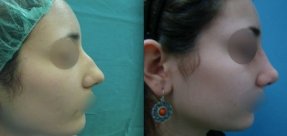 rinoplastiki-4a_thumb