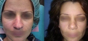 rinoplastiki-5a_thumb