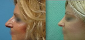 rinoplastiki-6a_thumb