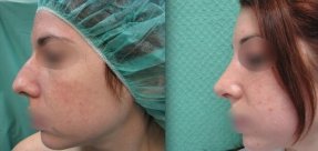rinoplastiki-7a_thumb
