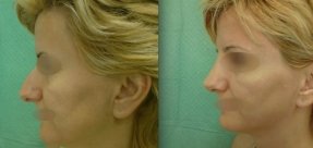 rinoplastiki-8a_thumb
