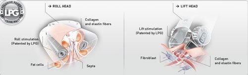Κυτταρίτιδα (Endermologie-LPG)