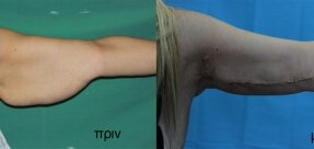 vrahionoplastiki-1a_thumb
