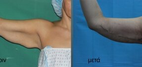 vrahionoplastiki-1b_thumb