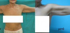 vrahionoplastiki-2a_thumb